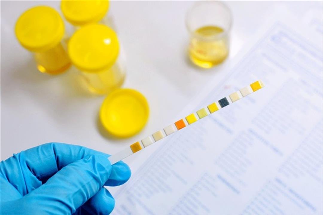 تغير لون البول